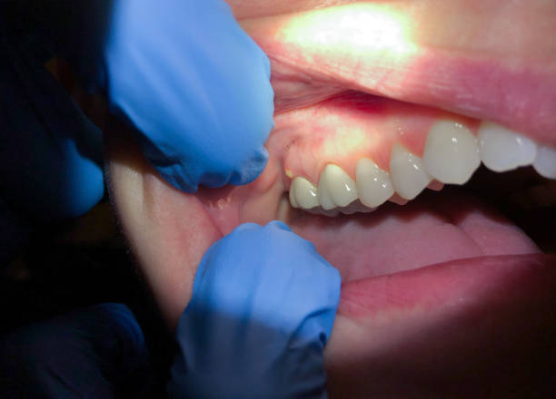 Best Emergency Dental Extractions in West Laurel, MD