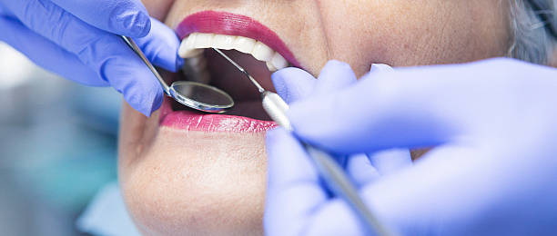 Best Emergency Dentist for Lost Fillings or Crowns in West Laurel, MD
